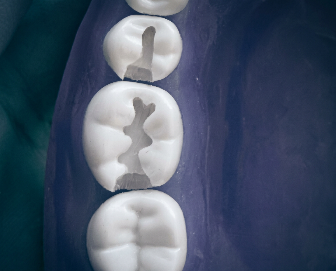 Typodont molars with class I and class II cavity preparations viewed occlusally
